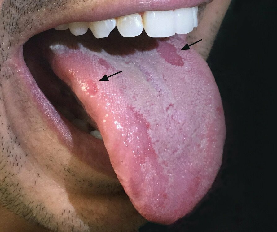 secondary-syphilisoral-lesions.jpg